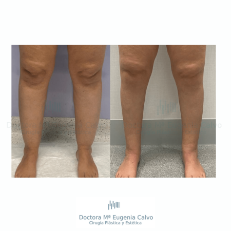 lipedema caso real