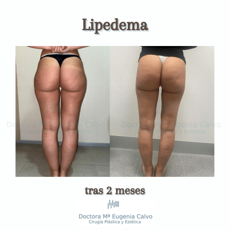 cirugía lipedema