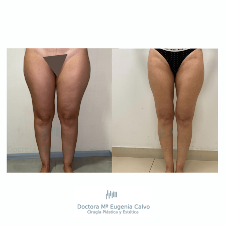 Lipedema cirugía