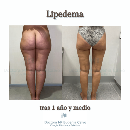 Lipedema cirugía