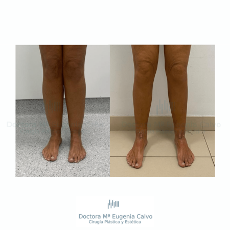 Lipedema cirugia caso real