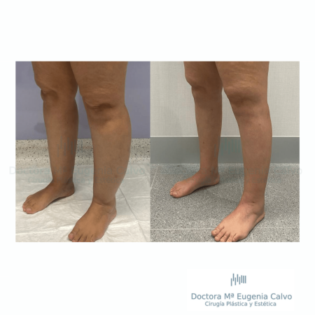 lipedema caso real