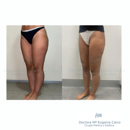cirugía lipedema