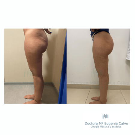 Lipedema cirugía