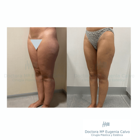 Lipedema cirugía