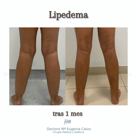 Lipedema cirugia caso real