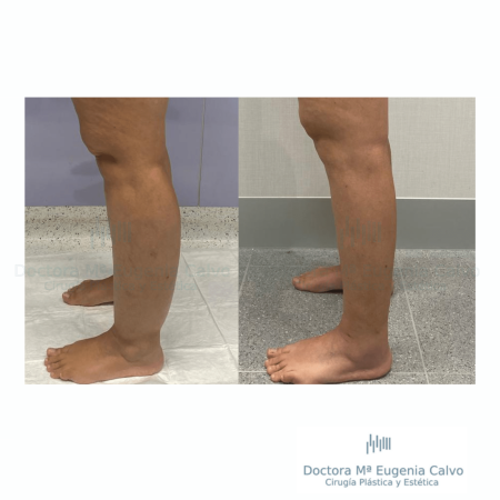 lipedema caso real