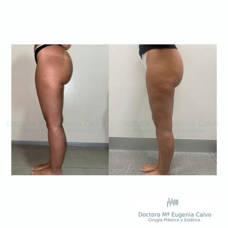 cirugía lipedema
