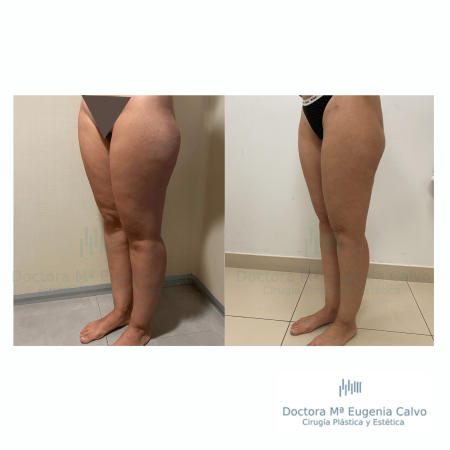 Lipedema cirugía