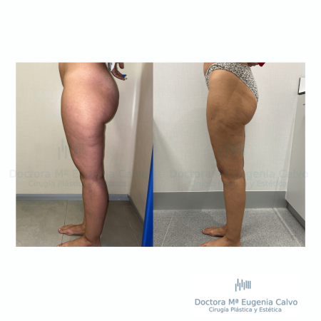 Lipedema cirugía