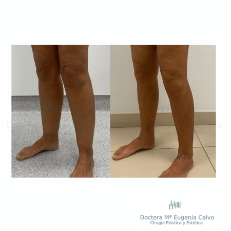Lipedema cirugia caso real