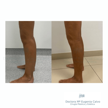 Lipedema cirugia caso real