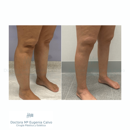 lipedema caso real