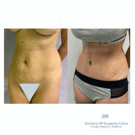 abdominoplastia sevilla caso real