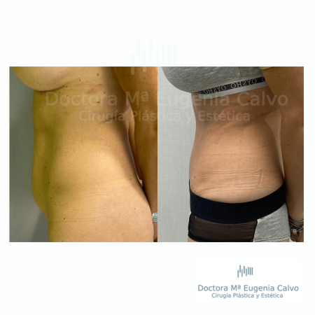 abdominoplastia sevilla caso real