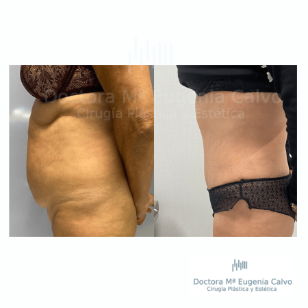 abdominoplastia y liposucción sevilla caso real