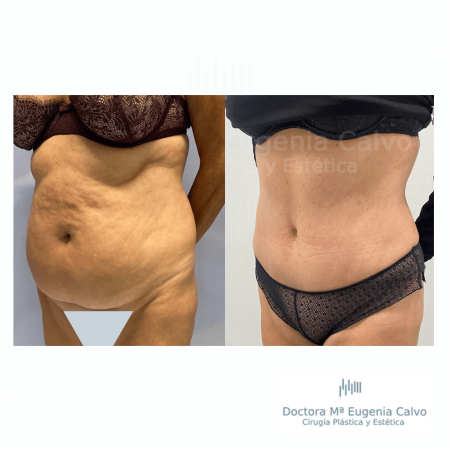 abdominoplastia y liposucción sevilla caso real